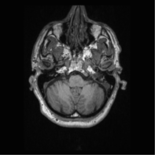 Alzheimer disease - probable (Radiopaedia 35334-36837 Axial T1 18).png