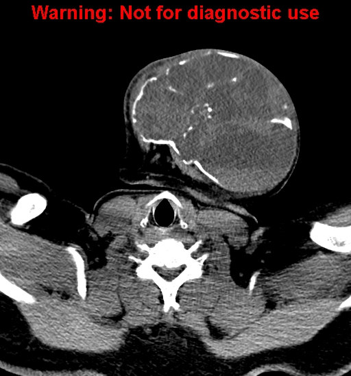 File:Ameloblastoma (Radiopaedia 33126-34164 A 28).jpg