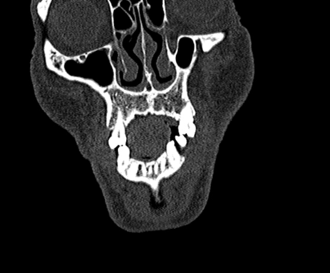 Ameloblastoma (Radiopaedia 51921-57766 Coronal bone window 33).jpg