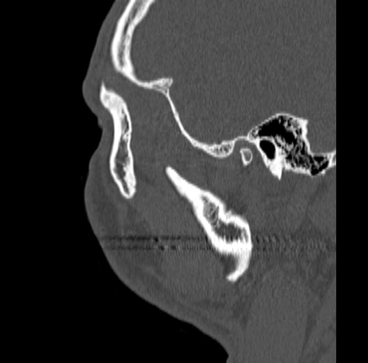 Ameloblastoma (Radiopaedia 77750-89997 Sagittal bone window 107).jpg