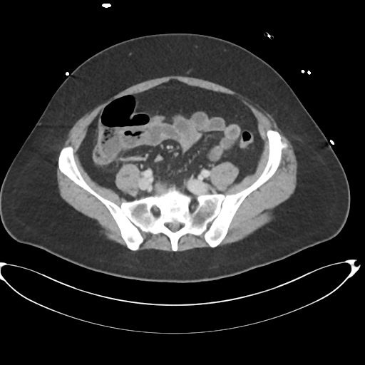 File:Amoebic liver abscess (Radiopaedia 52611-58530 A 72).png