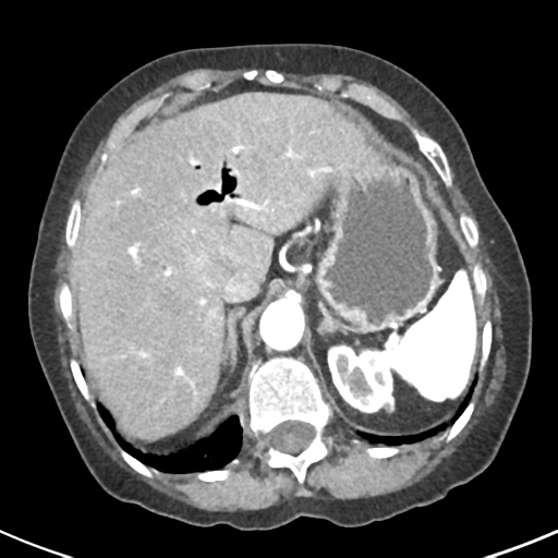 Ampullary adenocarcinoma (Radiopaedia 34013-35237 B 16).png