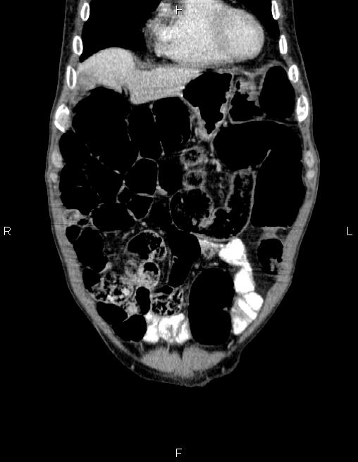 Ampullary adenocarcinoma (Radiopaedia 86093-102032 C 12).jpg