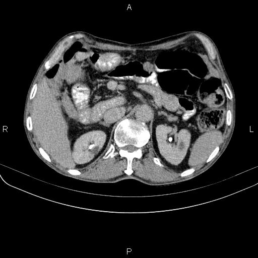 Ampullary adenocarcinoma (Radiopaedia 86093-102033 Axial C+ delayed 39).jpg