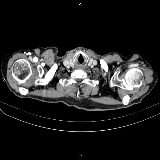 Ampullary adenocarcinoma (Radiopaedia 86093-102033 B 9).jpg