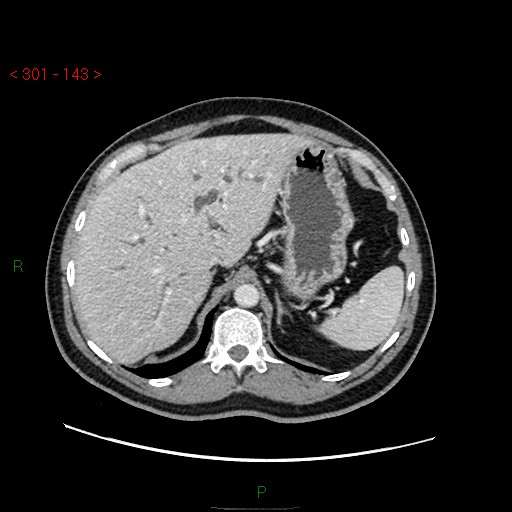 File:Ampullary carcinoma (Radiopaedia 56396-63056 C 23).jpg
