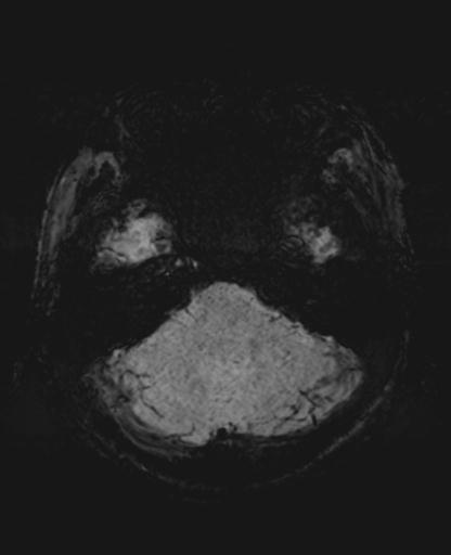 File:Amyloid angiopathy with inflammation (Radiopaedia 30360-31002 Axial SWI MIP 5).jpg