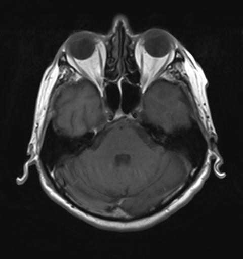 File:Amyloid angiopathy with inflammation (Radiopaedia 30360-31002 Axial T1 9).jpg