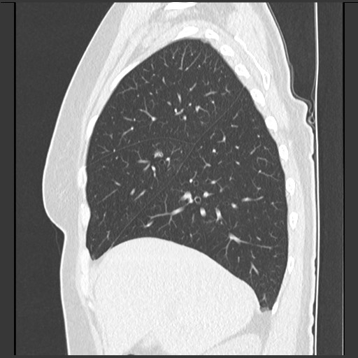 Amyloidosis - bronchial and diffuse nodular pulmonary involvement (Radiopaedia 60156-67744 F 15).jpg