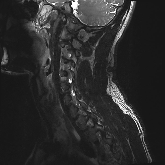 Amyotrophic lateral sclerosis (Radiopaedia 87352-103658 I 49).jpg