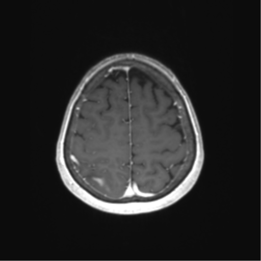 File:Anaplastic astrocytoma (Radiopaedia 86943-103160 Axial T1 C+ 70).png