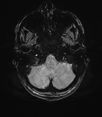 File:Anaplastic astrocytoma IDH mutant (Radiopaedia 50046-55341 Axial SWI 15).png