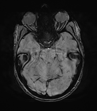File:Anaplastic astrocytoma IDH mutant (Radiopaedia 50046-55341 Axial SWI 31).png