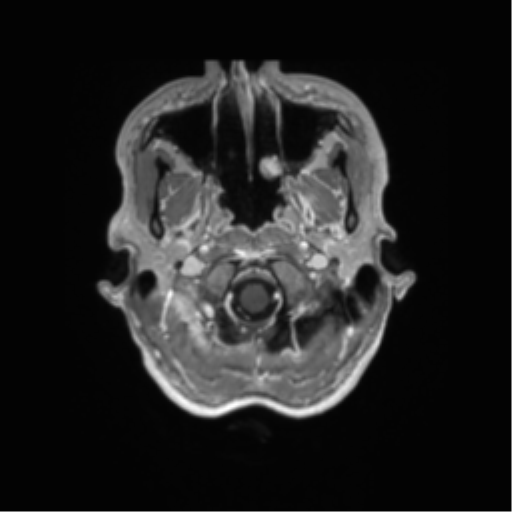 File:Anaplastic astrocytoma IDH mutant (Radiopaedia 50046-55341 Axial T1 C+ 5).png