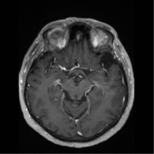 File:Anaplastic astrocytoma IDH wild-type (pseudoprogression) (Radiopaedia 42209-45276 Axial T1 C+ 64).png