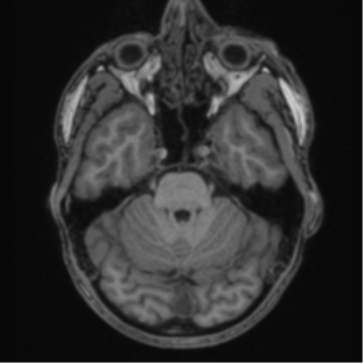 Anaplastic oligodendroglioma with skull fracture (Radiopaedia 74831-85845 Axial T1 16).png