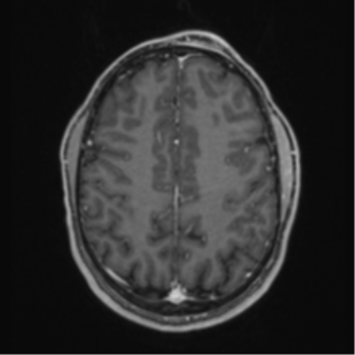 Anaplastic oligodendroglioma with skull fracture (Radiopaedia 74831-85845 Axial T1 C+ fat sat 47).png
