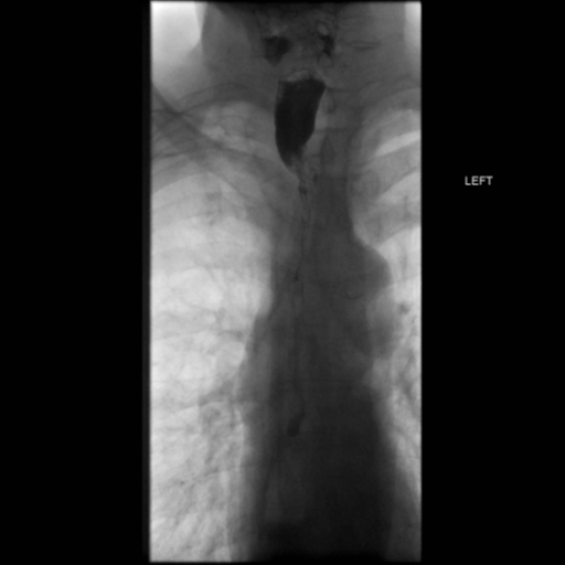 File:Anastomotic stricture post Ivor Lewis esophagectomy (Radiopaedia 47937-52715 B 5).png