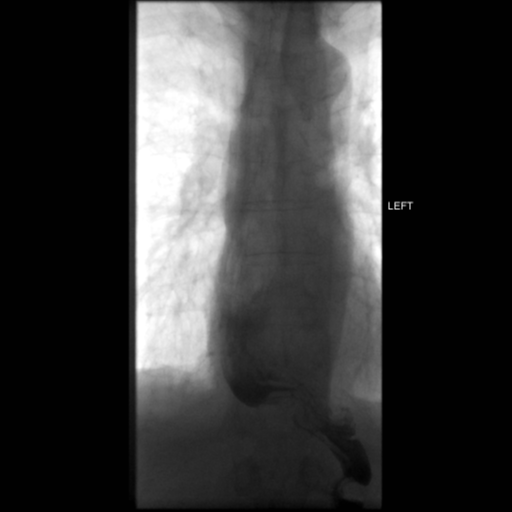 File:Anastomotic stricture post Ivor Lewis esophagectomy (Radiopaedia 47937-52715 C 10).png