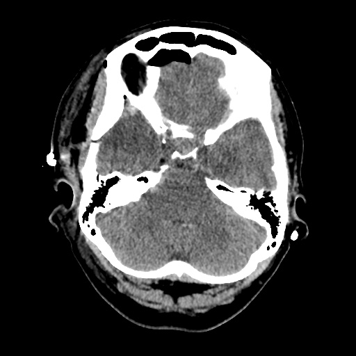 Aneursym related subarachnoid hemorrhage with hydrocephalus (Radiopaedia 45105-49085 Axial non-contrast 11).jpg
