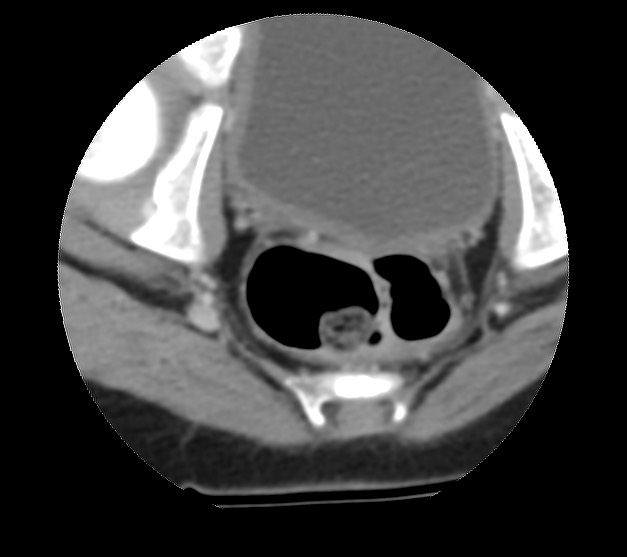 Aneurysmal bone cyst - sacrum (Radiopaedia 65190-74195 Axial non-contrast 42).jpg