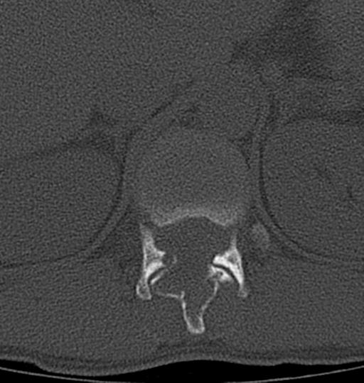 Aneurysmal bone cyst T11 (Radiopaedia 29294-29721 Axial bone window 49).jpg