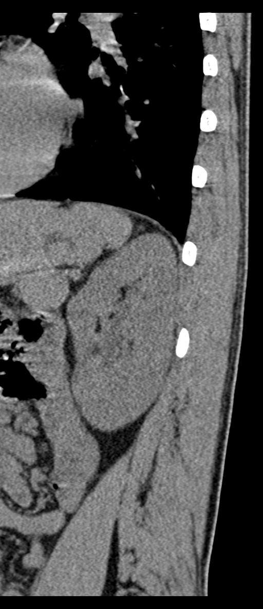 Aneurysmal bone cyst T11 (Radiopaedia 29294-29721 E 3).jpg