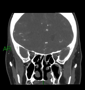 File:Aneurysmal subarachnoid hemorrhage with intra-axial extension (Radiopaedia 84371-99732 C 68).jpg