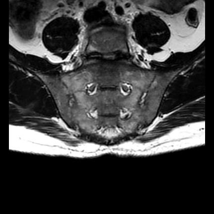 File:Ankylosing spondylitis with zygapophyseal arthritis (Radiopaedia 38433-40517 C 7).jpg
