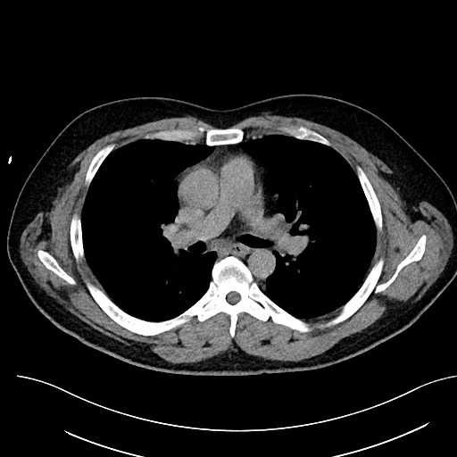 File:Anomalous origin of the left coronary artery with malignant course (Radiopaedia 77842-90126 Axial non-contrast 16).jpeg