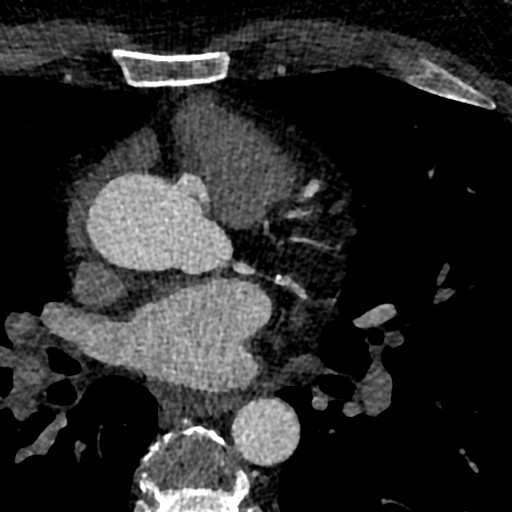File:Anomalous origin of the left coronary artery with malignant course (Radiopaedia 77842-90126 C 39).jpeg