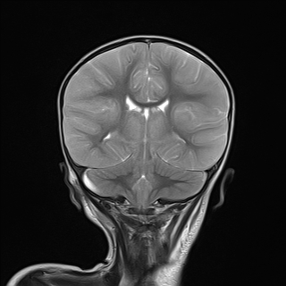 File:Anoxic brain injury (Radiopaedia 79165-92139 Coronal T2 18).jpg