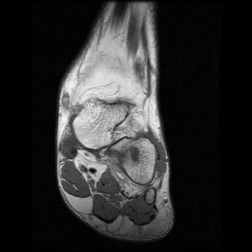 File:Anterior calcaneal process fracture (Radiopaedia 74654-85611 Coronal T1 6).jpg