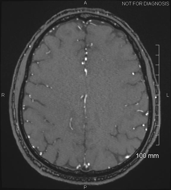 Anterior cerebral artery aneurysm (Radiopaedia 80683-94127 Axial MRA 174).jpg