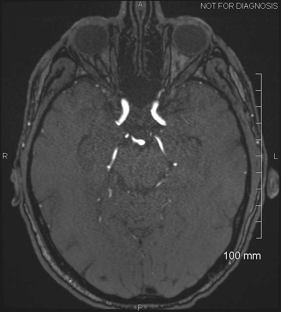 Anterior cerebral artery aneurysm (Radiopaedia 80683-94127 Axial MRA 91).jpg