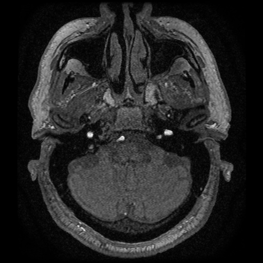 Anterior cerebral artery infarction (Radiopaedia 46794-51323 Axial MRA 12).jpg