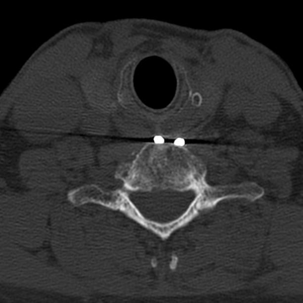 Anterior cervical postdiscectomy arthrodesis (Radiopaedia 32678-33646 Axial bone window 56).jpg