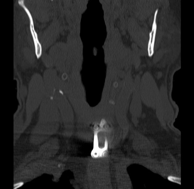 Anterior cervical postdiscectomy arthrodesis (Radiopaedia 32678-33646 Coronal bone window 8).jpg