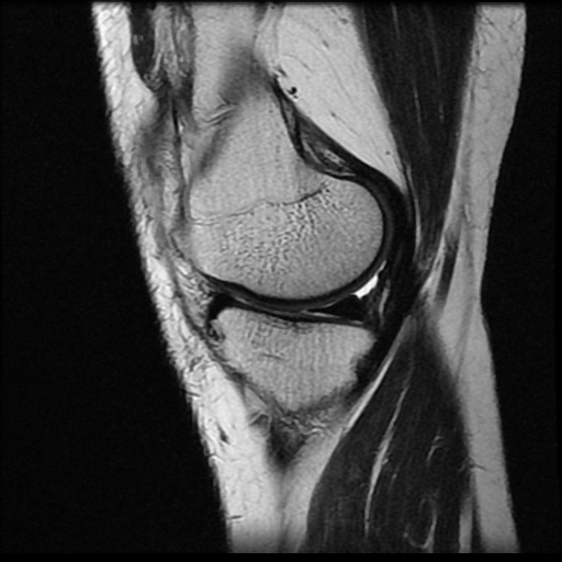 File:Anterior cruciate ligament avulsion fracture (Radiopaedia 58939-66193 Sagittal T2 16).jpg