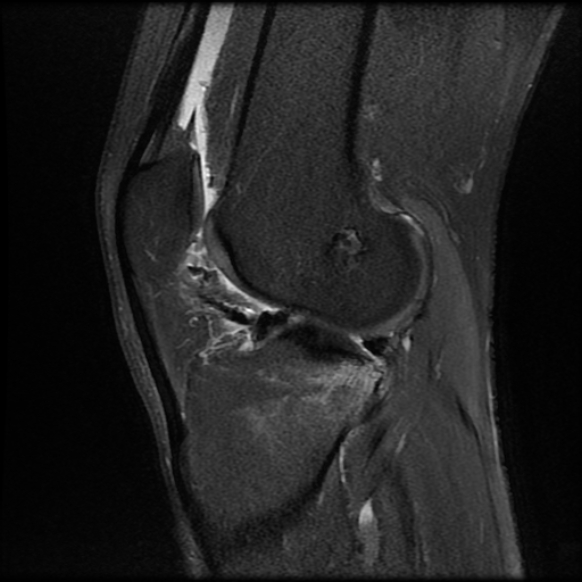 File:Anterior cruciate ligament graft tear and bucket-handle tear of medial meniscus (Radiopaedia 75867-87254 Sagittal PD fat sat 18).jpg