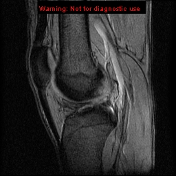 File:Anterior cruciate ligament injury - partial thickness tear (Radiopaedia 12176-12515 A 11).jpg