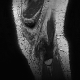 Anterior cruciate ligament rupture with Segond fracture (Radiopaedia 69043-78806 Sagittal PD 172).jpg
