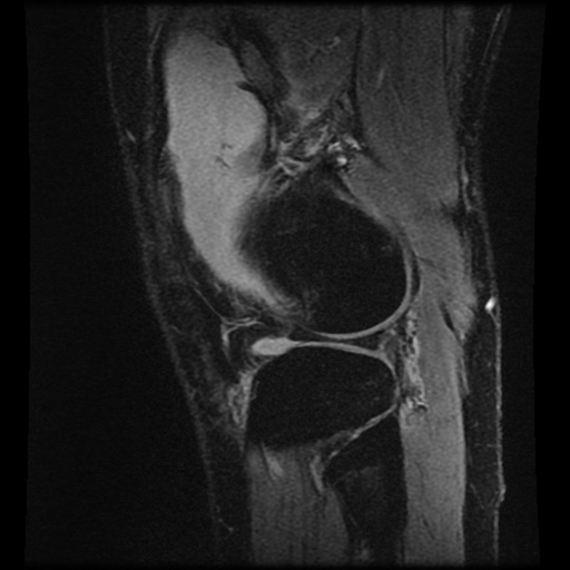 File:Anterior cruciate ligament tear (Radiopaedia 61500-69462 F 76).jpg