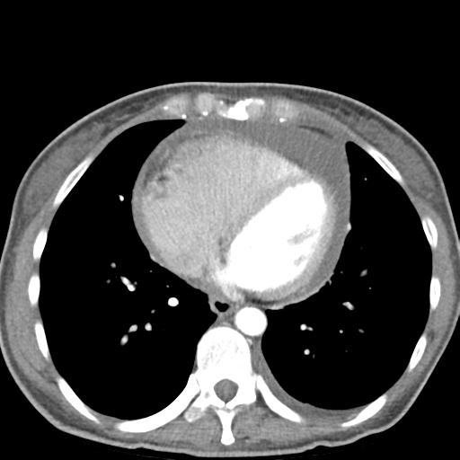 File:Anterior mediastinal lymphoma (Radiopaedia 29556-30061 C 38).jpg