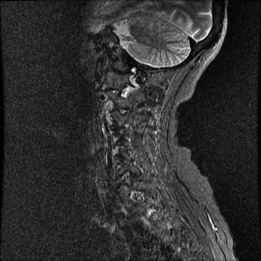 File:Anterior spinal artery syndrome (Radiopaedia 46335-50750 Sagittal STIR 10).png