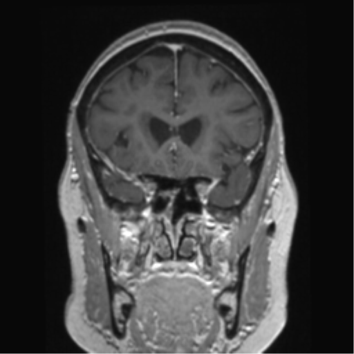 Anterior temporal pole cysts (Radiopaedia 46629-51102 Coronal T1 C+ 120).png