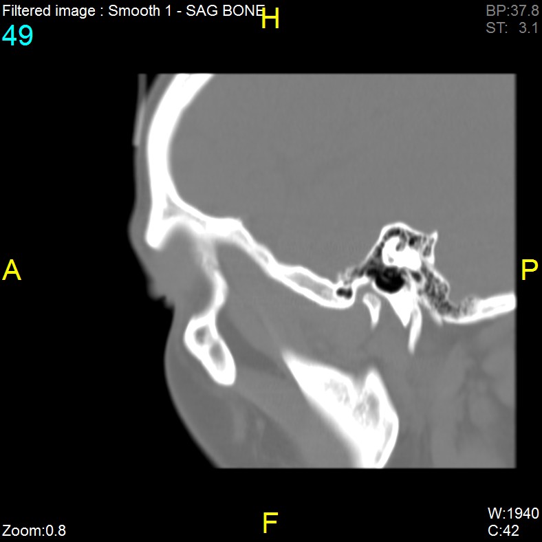 Antrochoanal polyp (Radiopaedia 65101-74094 Sagittal bone window 49).jpg