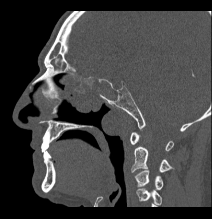 Antrochoanal polyp (Radiopaedia 79011-92169 Sagittal bone window 35).jpg