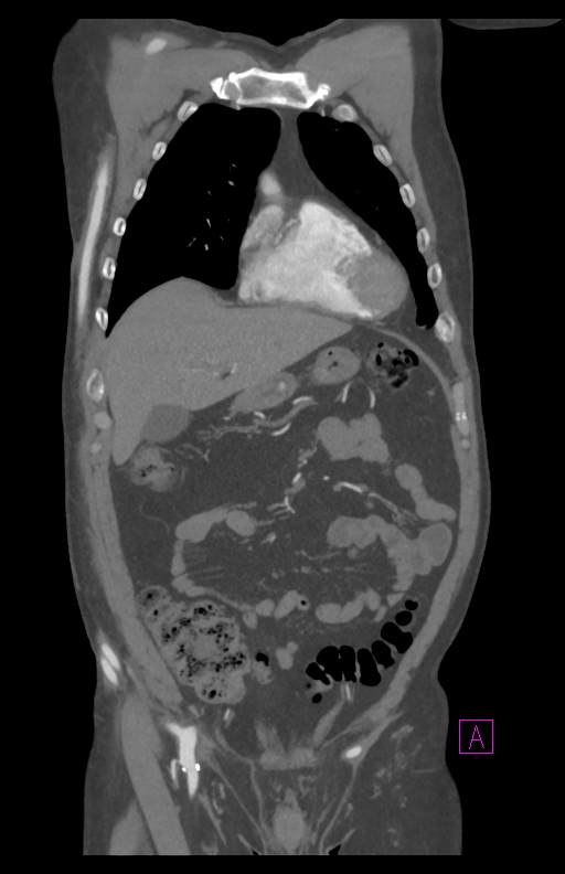 Aortectomy and axillary-bifemoral bypass (Radiopaedia 28303-28545 C 28).jpg