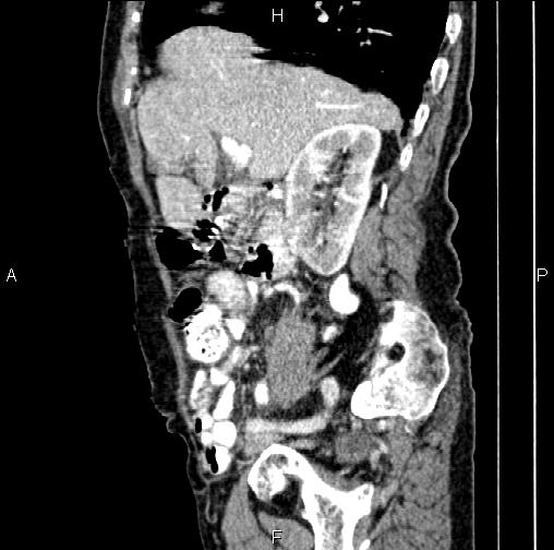 File:Aortic aneurysm and Lemmel syndrome (Radiopaedia 86499-102554 D 27).jpg